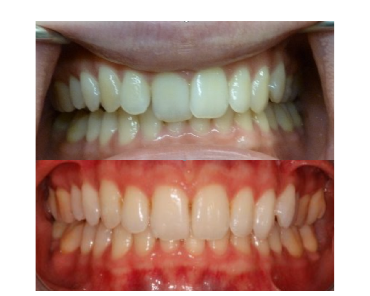 before and after teeth straightening